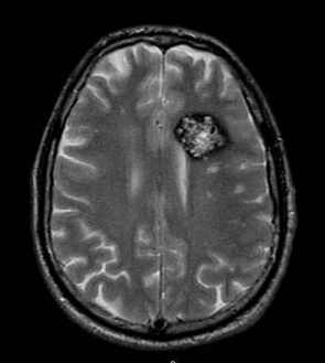 Cavernoma FSE T2 assiale. Da questa immagine appare evidente come i cavernomi si presentino come lesioni di tipo tumorale.